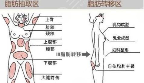 抽脂隆胸