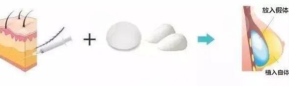 八大处杨庆华医生隆胸案例