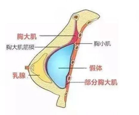脂肪丰胸
