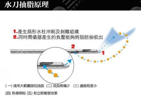 水动力吸脂原理