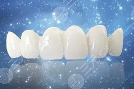 全瓷牙套