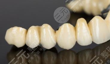 全瓷牙套