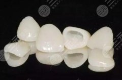 全瓷牙冠哪个牌子好？国产品牌&选购建议分享！2022价格参考~