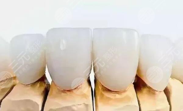 全瓷牙冠