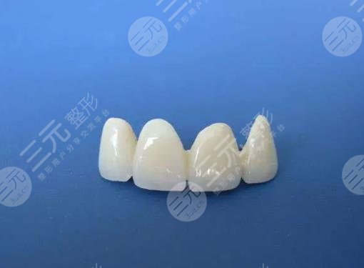 全瓷牙冠