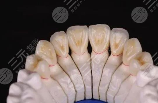 全瓷牙套
