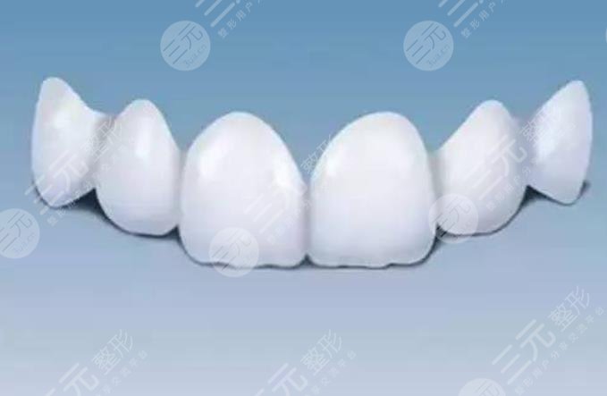 全瓷牙套