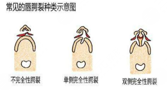 唇腭裂鼻子修复多大年龄合适？唇腭裂修复过程和时间需要多久？