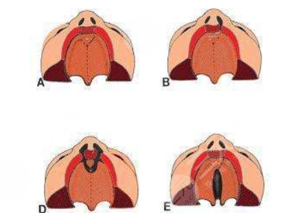 唇腭裂修复过程和时间需要多久？