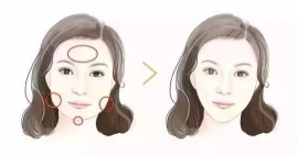 创可贴面部吸脂案例丨告别大饼脸，即可拥有小V脸