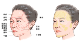 创可贴面部吸脂案例丨告别大饼脸，即可拥有小V脸