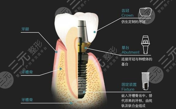 兰州做种植牙案例