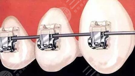 南京做牙齿矫正科普