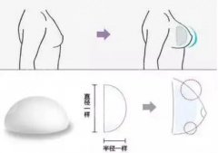 曼托水滴好还是圆形好？隆胸假体区别对比，美胸指南！