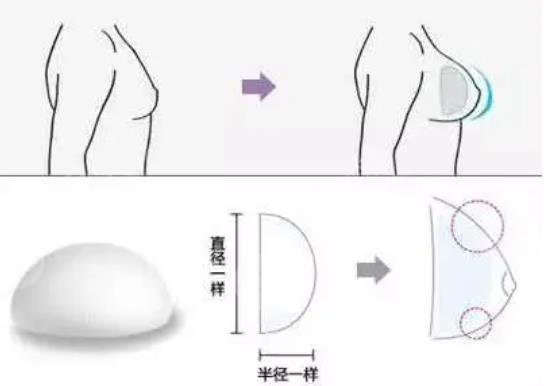 曼托假体
