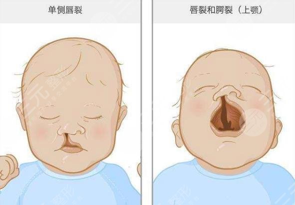 兔唇修复的手术要隔多久再做?