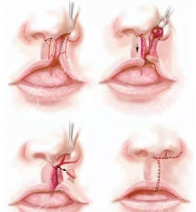 兔唇修复手术有哪些优势?