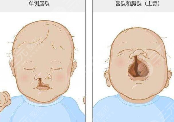 北京八大处做唇裂修复术案例