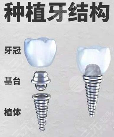 深圳种植牙项目科普