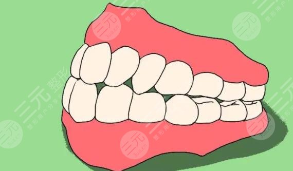 活动假牙