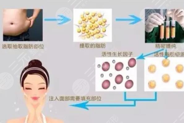 隆下巴