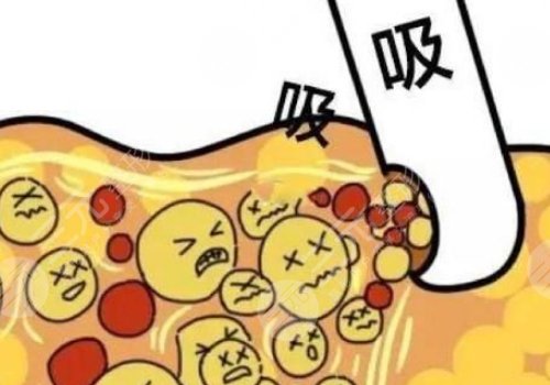 自体脂肪隆胸