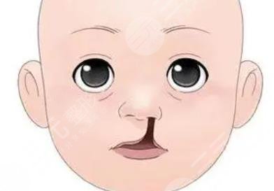 北京南加医疗美容医院做二期唇腭裂修复手术技术较为不错,手术价格也