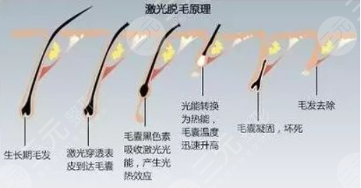 冰点脱毛和激光脱毛哪个果好?原理深扒!附价格一览2022 冰点脱毛和激光脱毛哪个果好?原理深扒!附价格一览2022