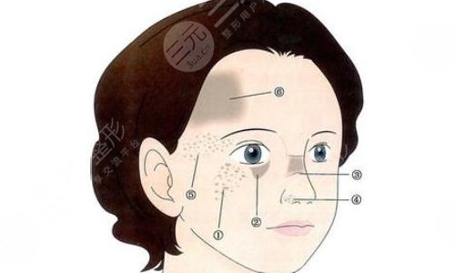 激光去胎记要多少时间才能恢复好?