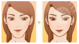 张寒下颌角整容案例：轻松获得小V脸一枚~