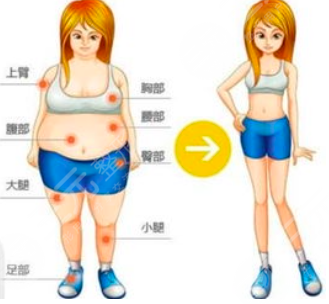 上海九院吸脂多少钱？价格表一览&腰腹吸脂案例分享~