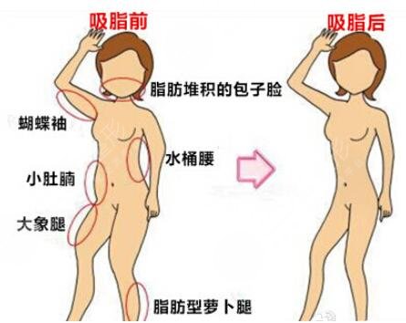 上海九院吸脂多少钱？价格表一览&腰腹吸脂案例分享~