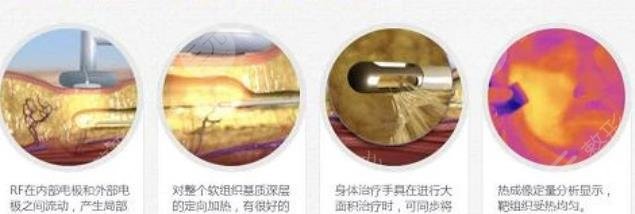 吸脂