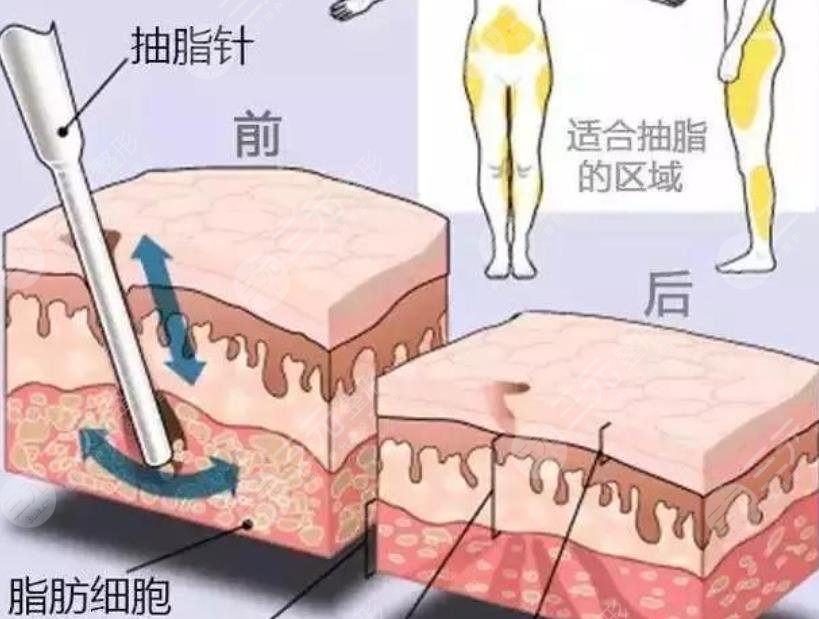 吸脂