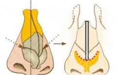 歪鼻矫正手术是怎么做的?科普全过程,助力你重塑美鼻! 歪鼻矫正手术是怎么做的?科普全过程,助力你重塑美鼻!