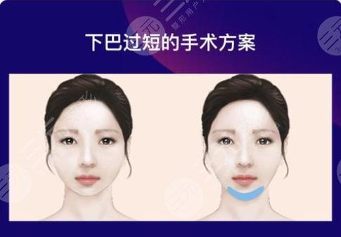 垫下巴