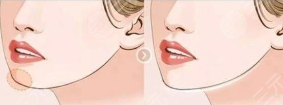 隆下巴