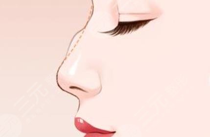 驼峰鼻矫正手术怎么做？3种整形方法科普，美鼻知识get！