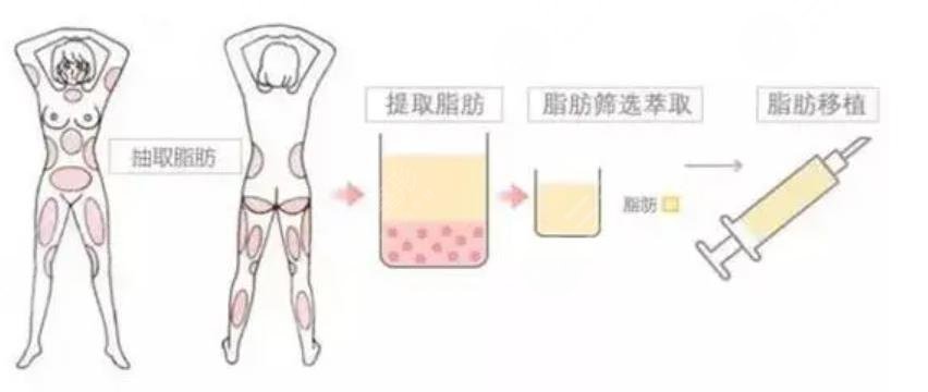 隆胸