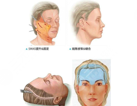 拉皮手术伤口会不会留疤？疤痕多久消失？手术注意事项30秒速读