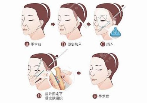 拉皮手术前注意事项