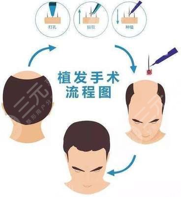 河南植发正规医院