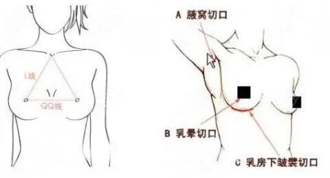 与个人胸部情况有关