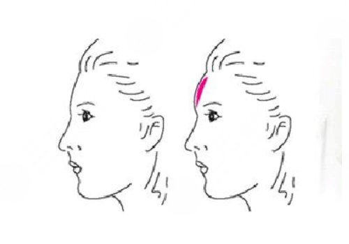 自体脂肪丰额头多少钱？高吗？价格表一览+注意事项