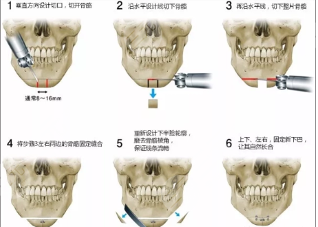 磨颧骨禁忌人群有哪些