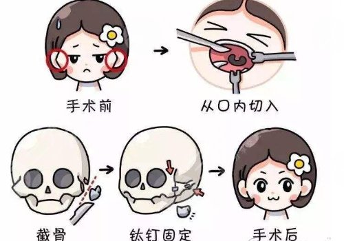 磨颧骨有什么风险后遗症?这类人群不可以做磨骨! 磨颧骨有什么风险后遗症?这类人群不可以做磨骨!