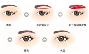 提眉术前后对比照片