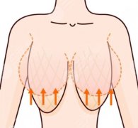 乳房缩小提升术有哪些风险?需要多少钱?一文全了解 乳房缩小提升术有哪些风险?需要多少钱?一文全了解