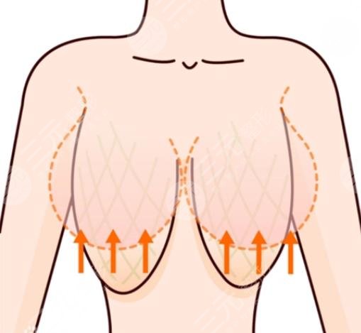 乳房缩小提升