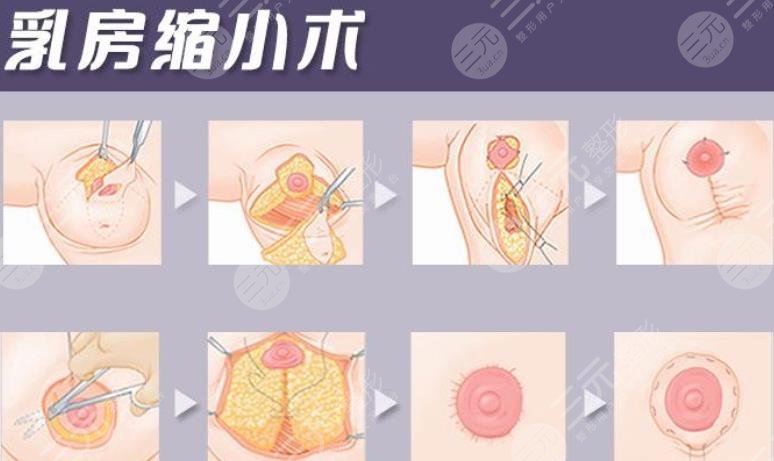 乳房缩小提升